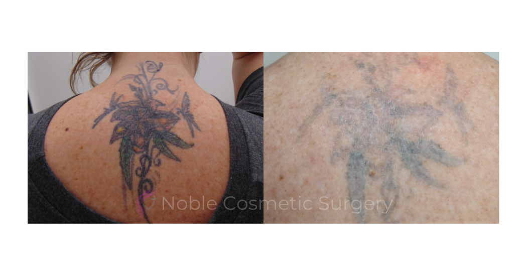 LASER-TATTOO-REMOVAL-CASE-00009 | Before and After Laser Tattoo Removal