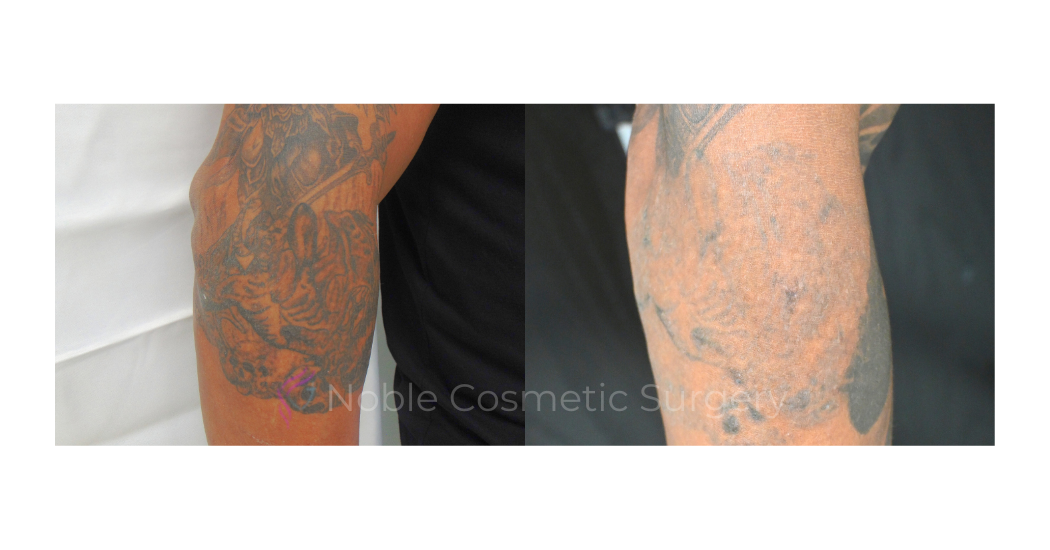 LASER-TATTOO-REMOVAL-CASE-00010 | Before and After Laser Tattoo Removal
