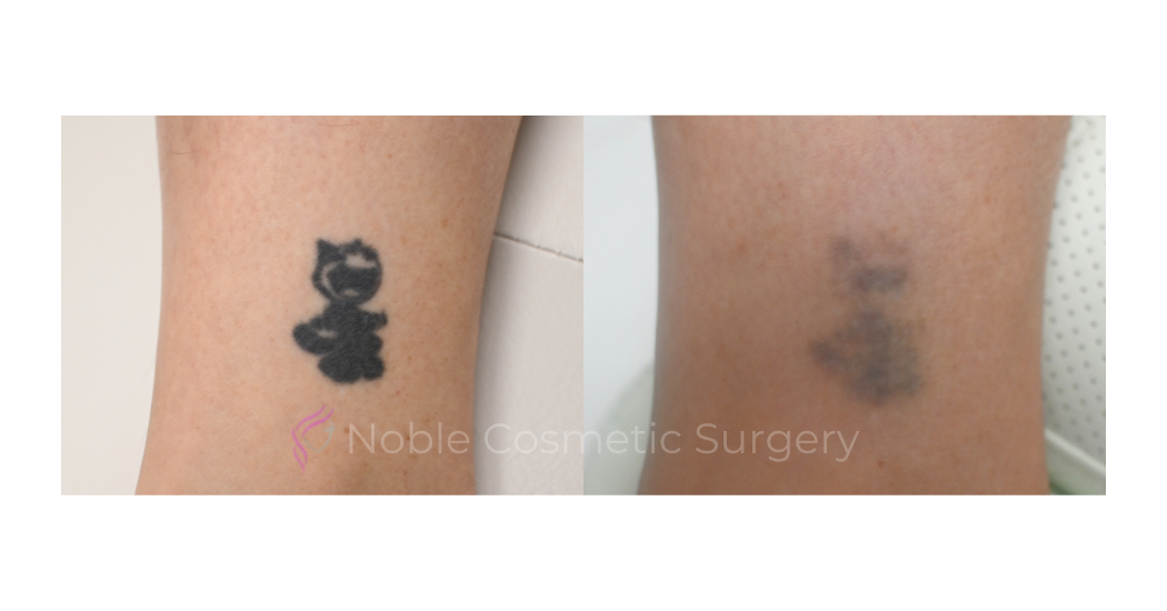 LASER-TATTOO-REMOVAL-CASE-00011 | Before and After Laser Tattoo Removal