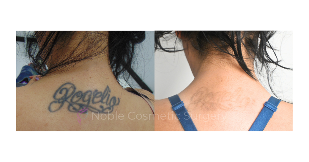LASER-TATTOO-REMOVAL-CASE-00012 | Before and After Laser Tattoo Removal