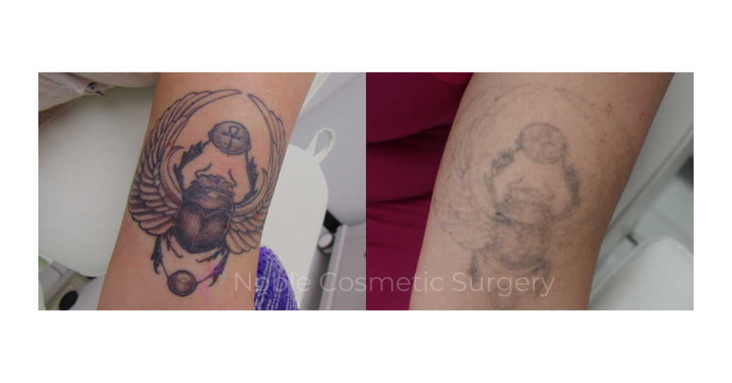 LASER-TATTOO-REMOVAL-CASE-00013 | Before and After Laser Tattoo Removal