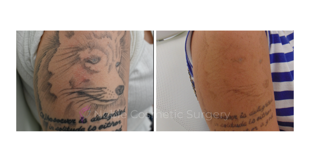 LASER-TATTOO-REMOVAL-CASE-00015 | Before and After Laser Tattoo Removal