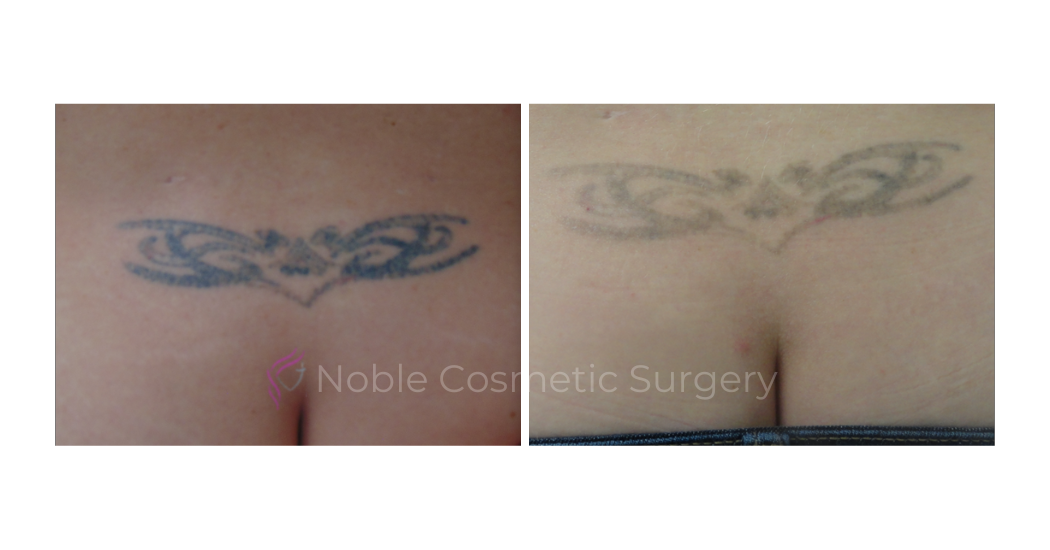 LASER-TATTOO-REMOVAL-CASE-00016 | Before and After Laser Tattoo Removal