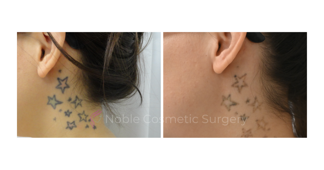 LASER-TATTOO-REMOVAL-CASE-00017 | Before and After Laser Tattoo Removal