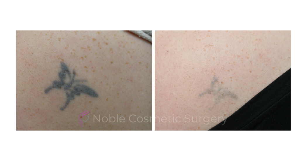 LASER-TATTOO-REMOVAL-CASE-00018 | Before and After Laser Tattoo Removal