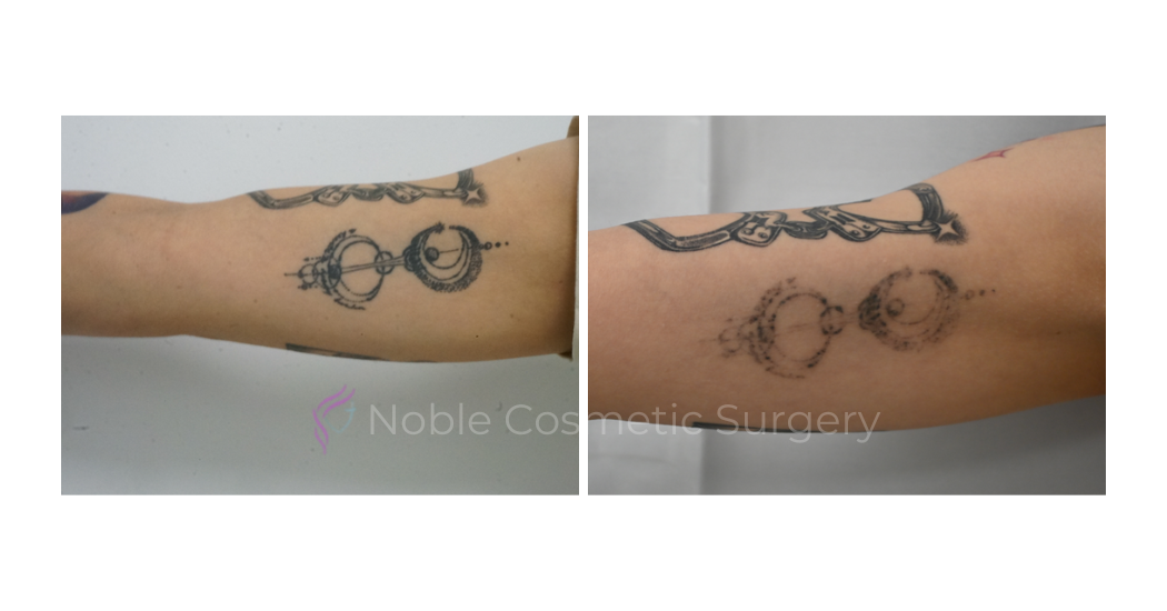 LASER-TATTOO-REMOVAL-CASE-00019 | Before and After Laser Tattoo Removal