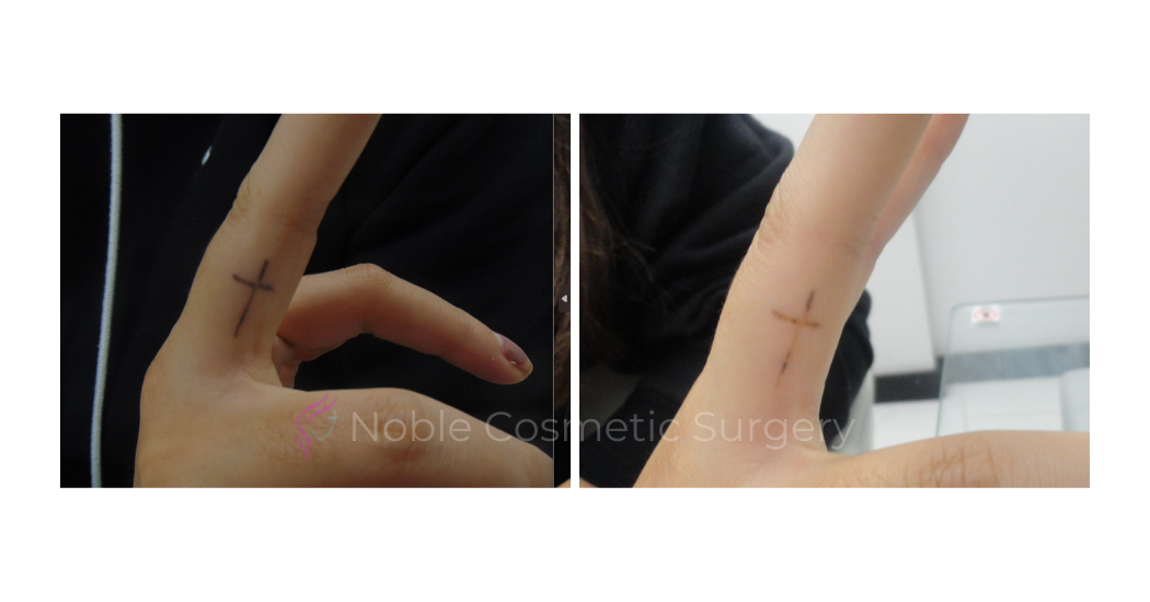 LASER-TATTOO-REMOVAL-CASE-00020 | Before and After Laser Tattoo Removal
