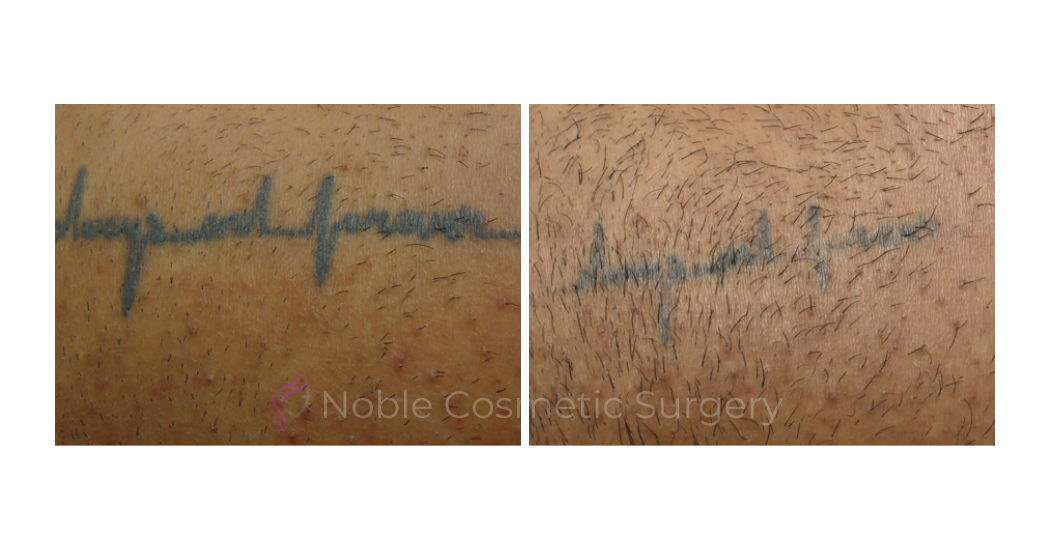 LASER-TATTOO-REMOVAL-CASE-00021 | Before and After Laser Tattoo Removal