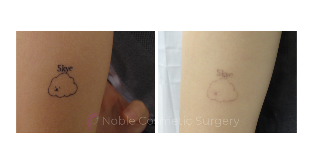 LASER-TATTOO-REMOVAL-CASE-00022 | Before and After Laser Tattoo Removal