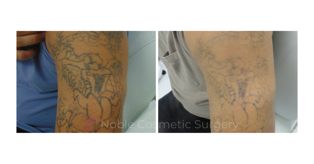 LASER-TATTOO-REMOVAL-CASE-00023 | Before and After Laser Tattoo Removal