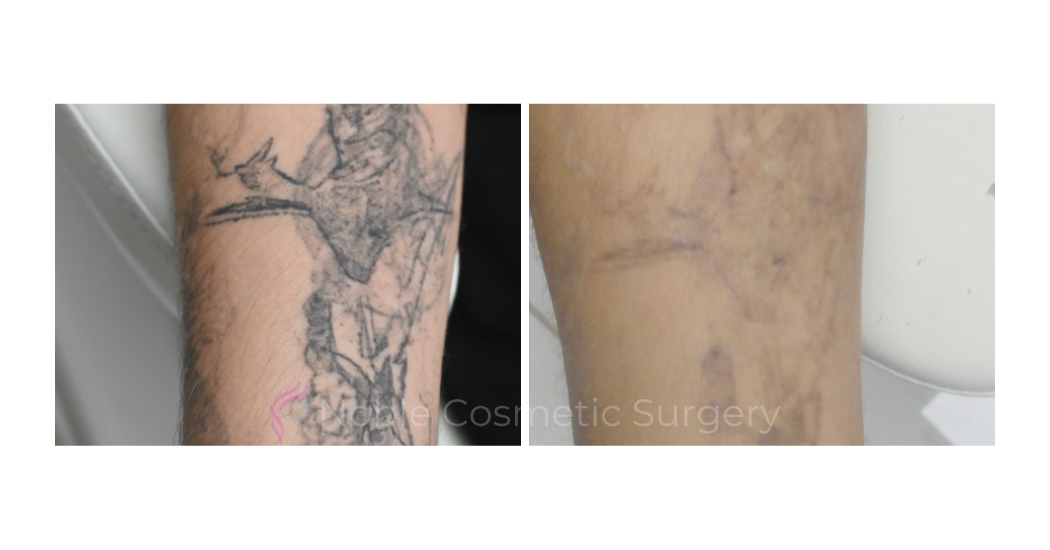 LASER-TATTOO-REMOVAL-CASE-00024 | Before and After Laser Tattoo Removal