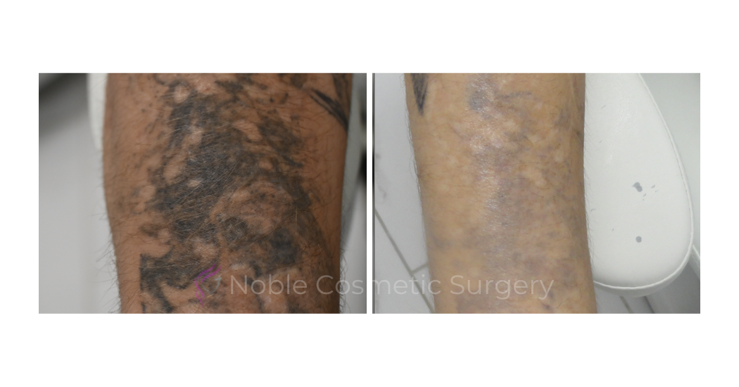 LASER-TATTOO-REMOVAL-CASE-00025 | Before and After Laser Tattoo Removal