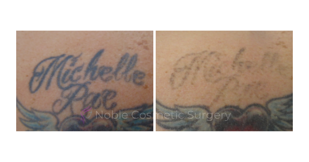 LASER-TATTOO-REMOVAL-CASE-00026 | Before and After Laser Tattoo Removal