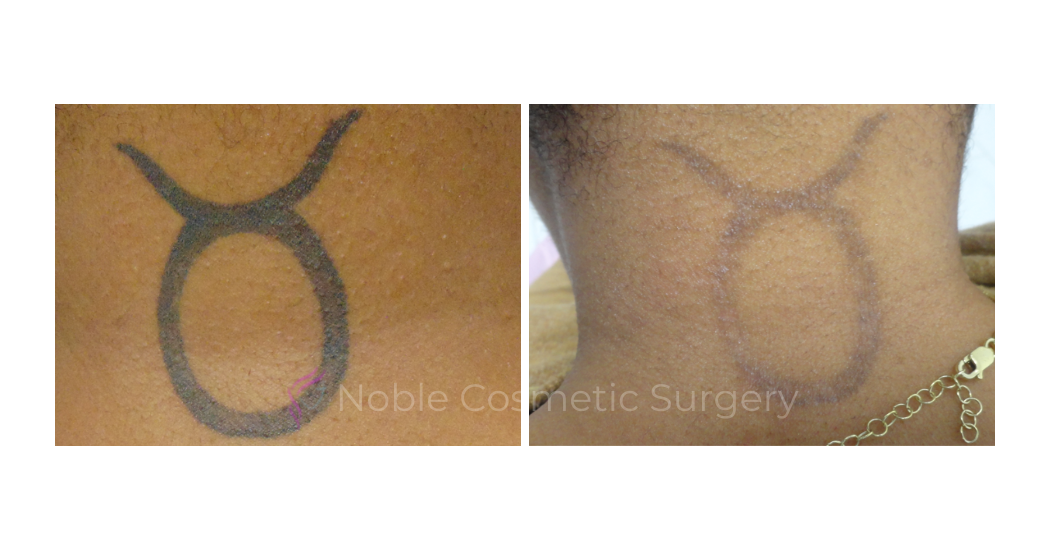 LASER-TATTOO-REMOVAL-CASE-00027 | Before and After Laser Tattoo Removal 1