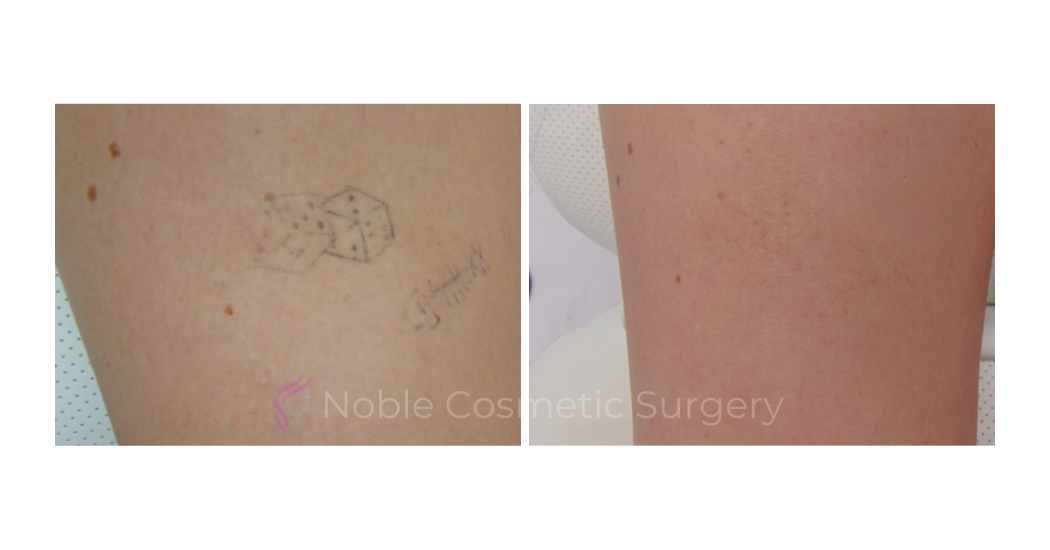 LASER-TATTOO-REMOVAL-CASE-00028 | Before and After Laser Tattoo Removal 1