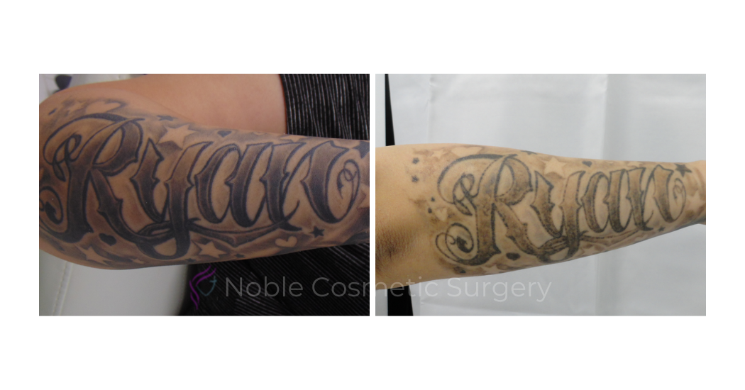 LASER-TATTOO-REMOVAL-CASE-00029 | Before and After Laser Tattoo Removal 1