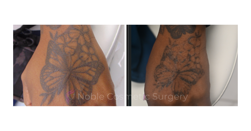 LASER-TATTOO-REMOVAL-CASE-00030 | Before and After Laser Tattoo Removal 1
