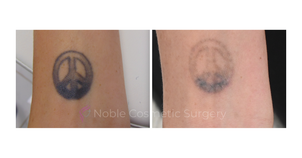 LASER-TATTOO-REMOVAL-CASE-00031 | Before and After Laser Tattoo Removal 1