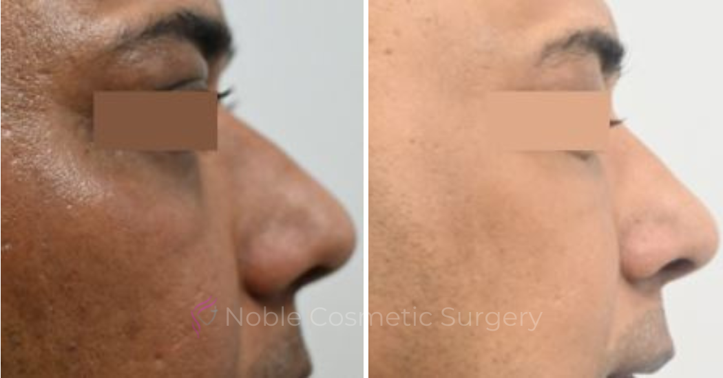 LIQUID-RHINOPLASTY-CASE-10001 | Before and After Liquid Rhinoplasty