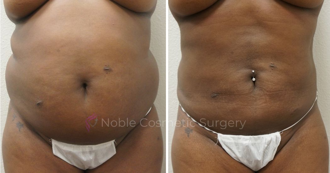 Liposuction 1