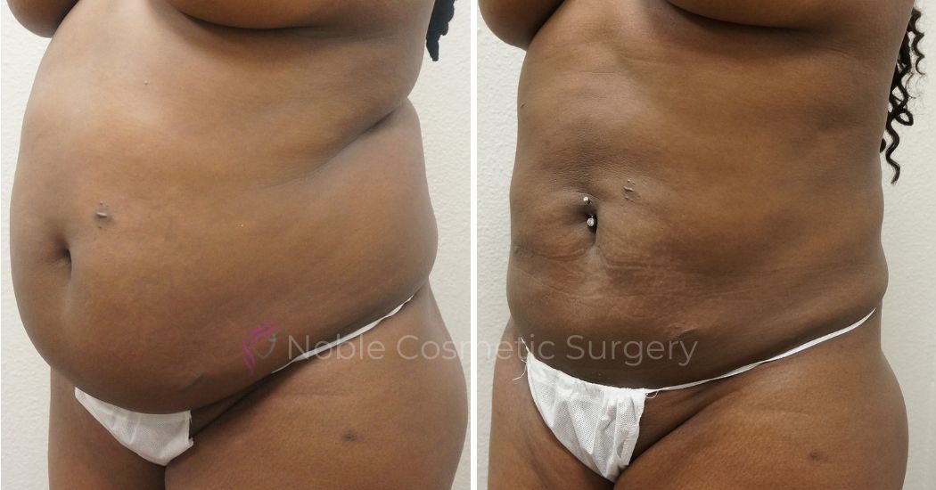 P0-00900L | Before and After Liposuction 2