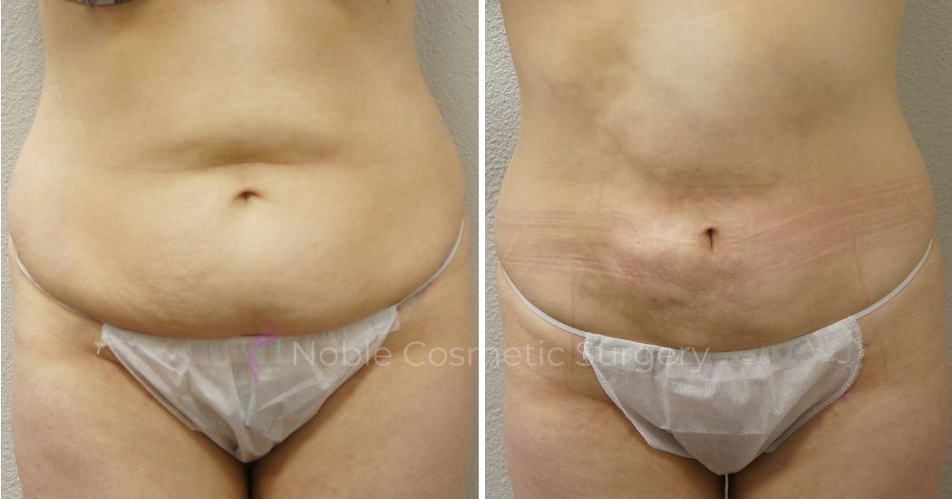 Liposuction 2