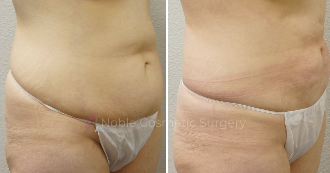 P1-00901L | Before and After Liposuction 2