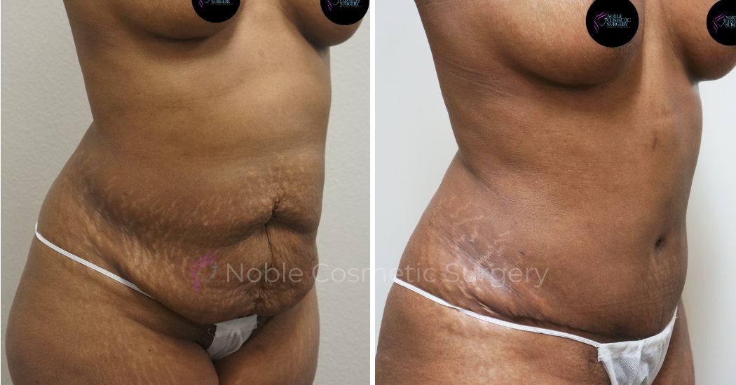 P10-00041A | Before and After Abdominoplasty 2