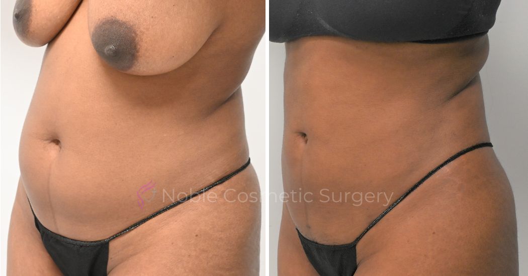 P10-00910L | Before and After Liposuction 2