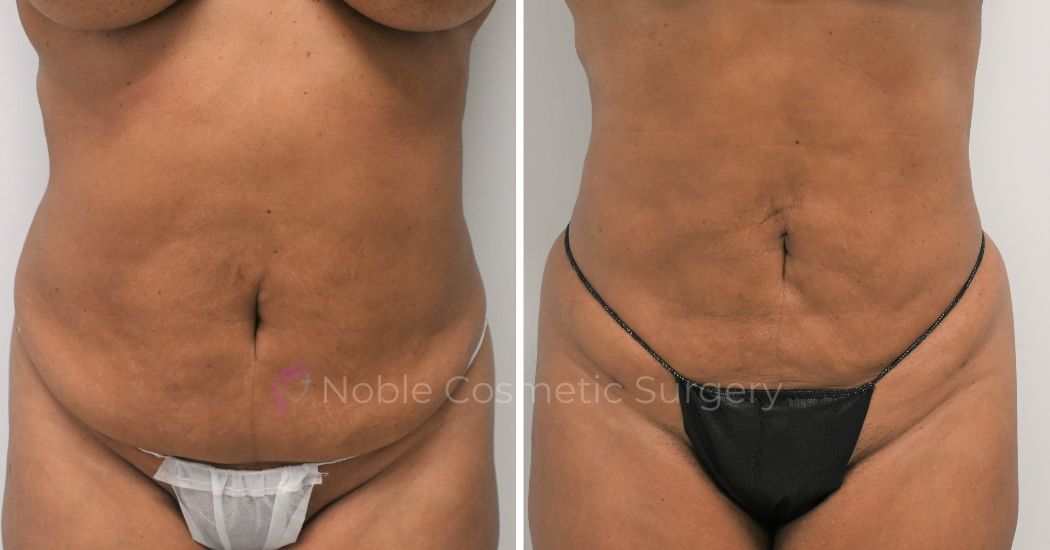 P11-00911L | Before and After Liposuction 1