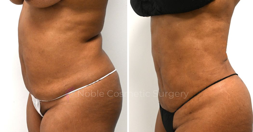 P11-00911L | Before and After Liposuction 2