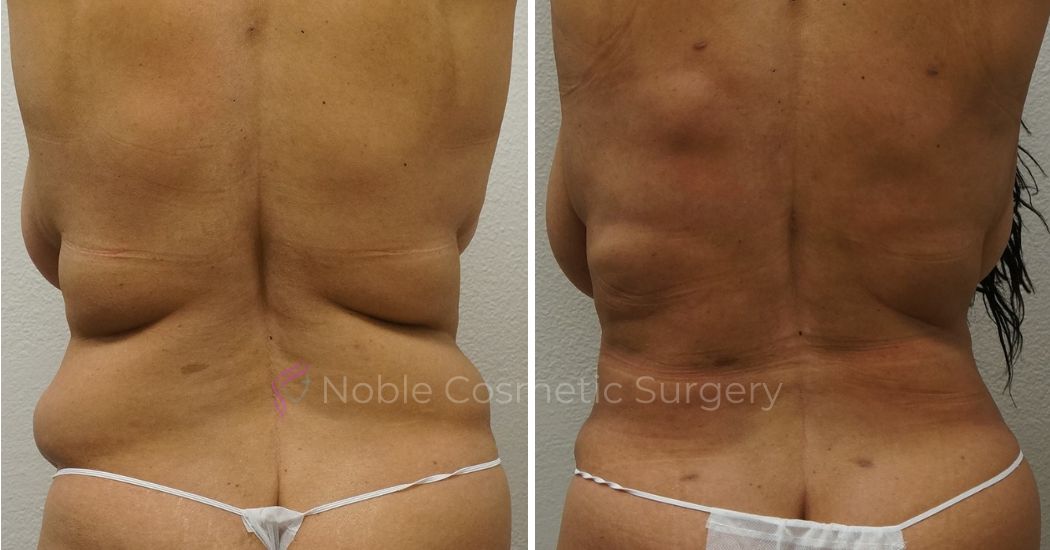 P12-00043A | Before and After Abdominoplasty 3
