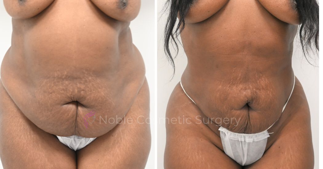 P12-00912L | Before and After Liposuction 1
