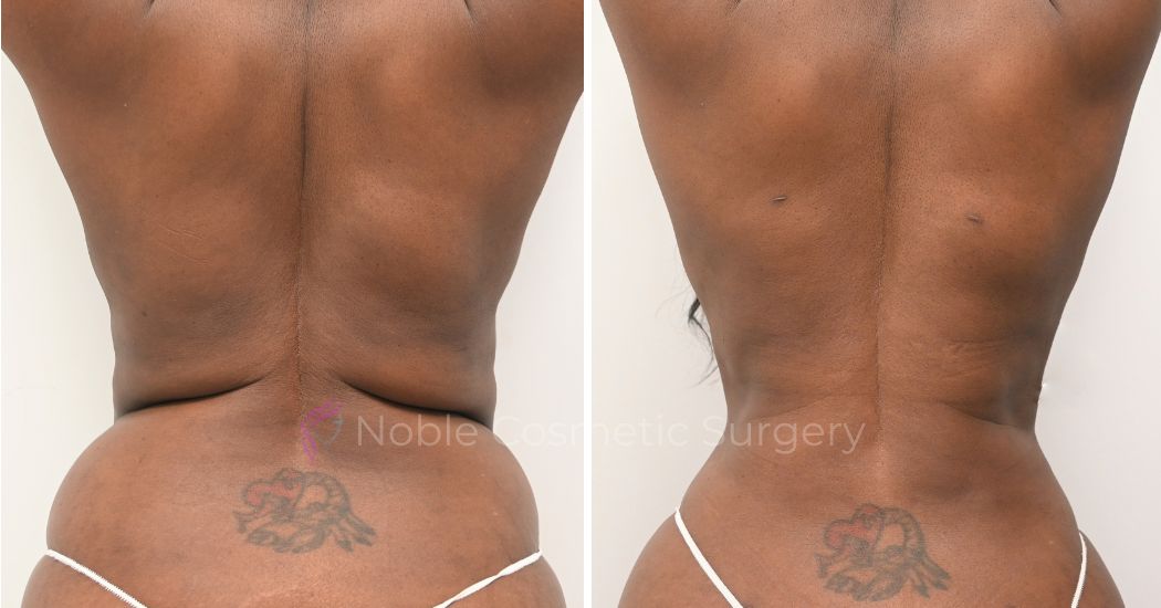 P12-00912L | Before and After Liposuction 2