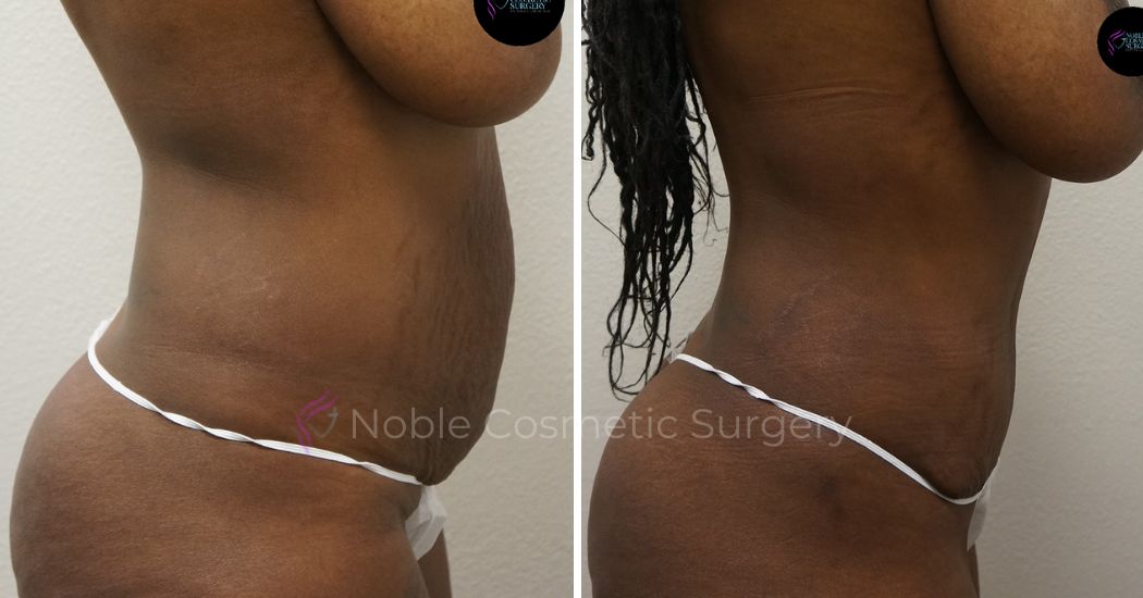 P13-00044A | Before and After Abdominoplasty 2