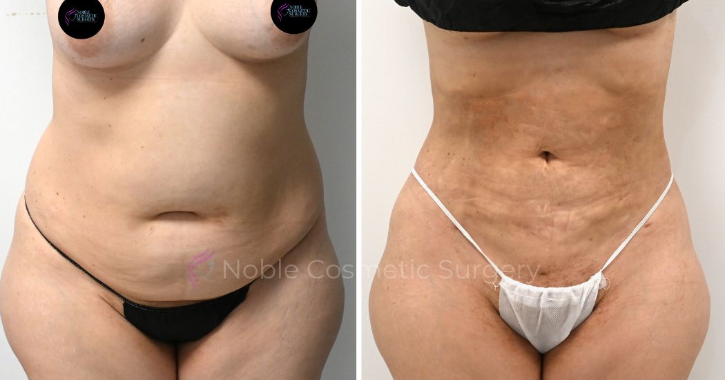 P13-00913L | Before and After Liposuction 1