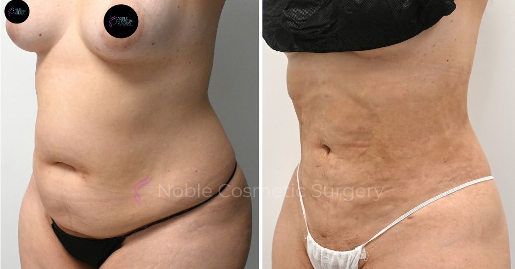 P13-00913L | Before and After Liposuction 2