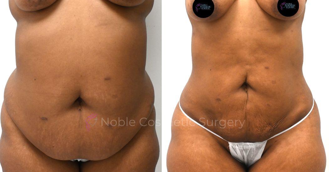 P14-00914L | Before and After Liposuction 1