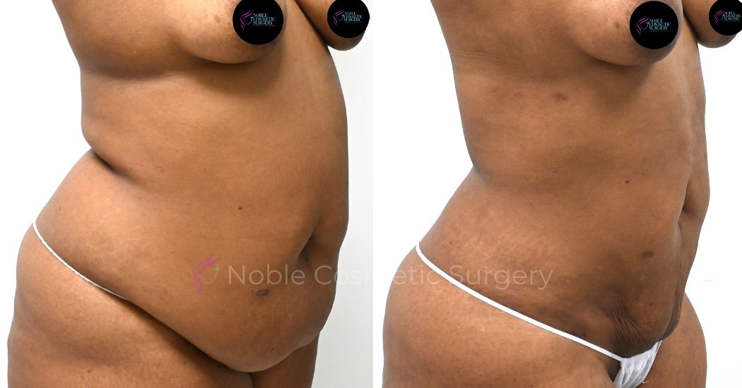 P14-00914L | Before and After Liposuction 2