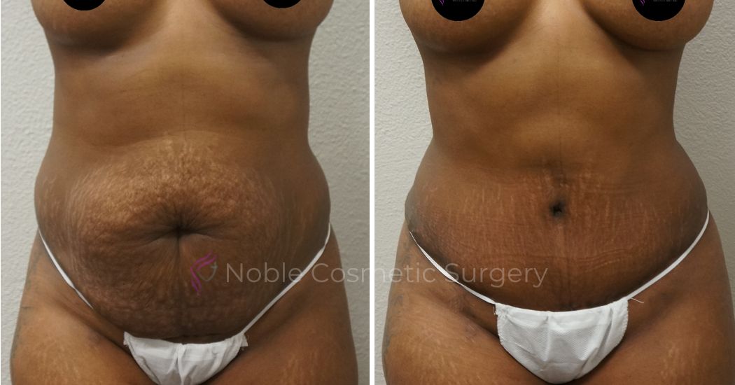 P15-00046A | Before and After Abdominoplasty 1
