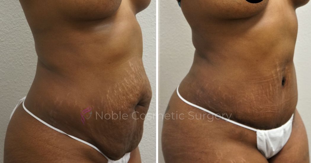 P15-00046A | Before and After Abdominoplasty 2