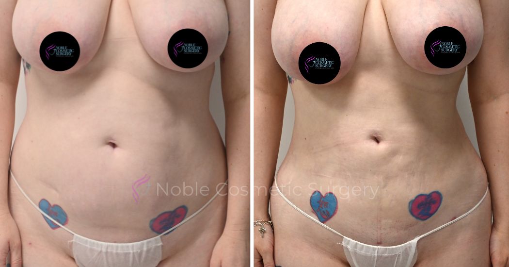 P15-00915L | Before and After Liposuction 1