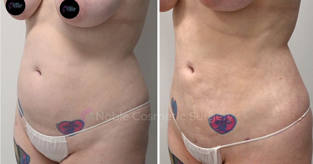 P15-00915L | Before and After Liposuction 2