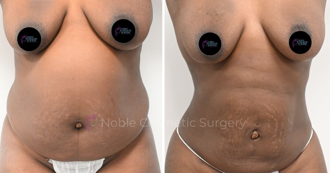 P16-00916L | Before and After Liposuction 1