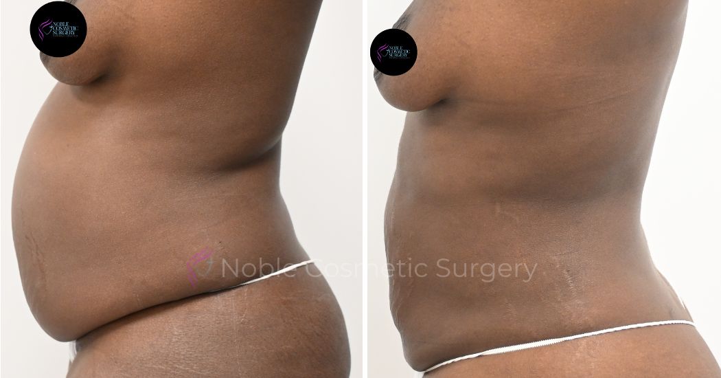 P16-00916L | Before and After Liposuction 2