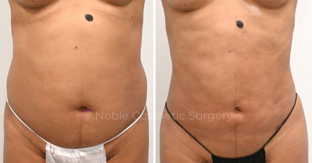 P17-00917L | Before and After Liposuction 1