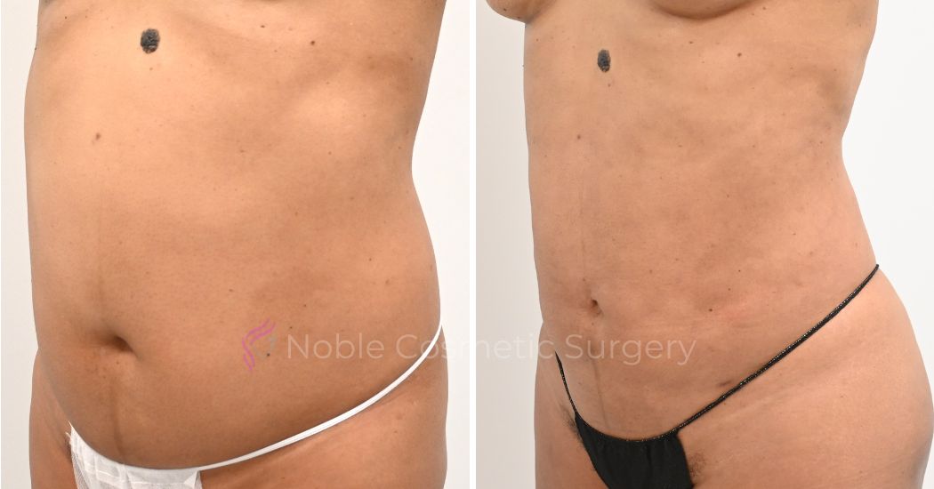 P17-00917L | Before and After Liposuction 2