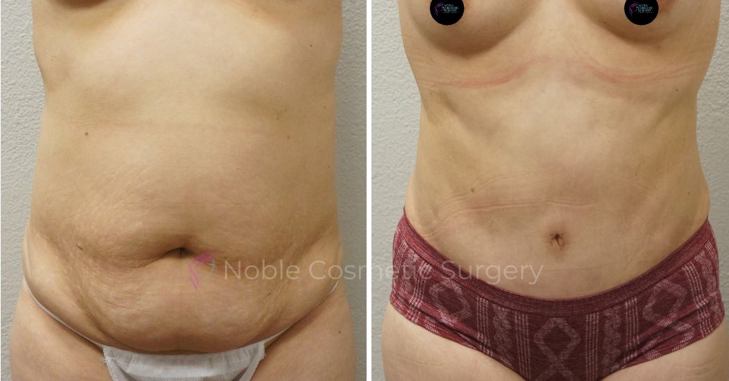 P18-00049A | Before and After Abdominoplasty 1
