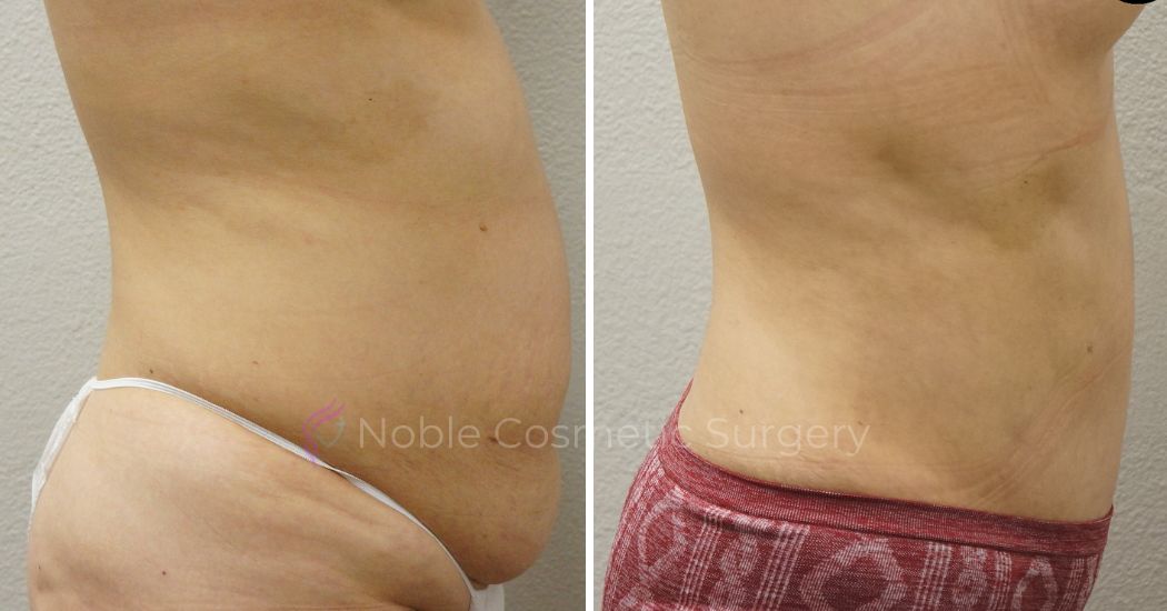 P18-00049A | Before and After Abdominoplasty 2