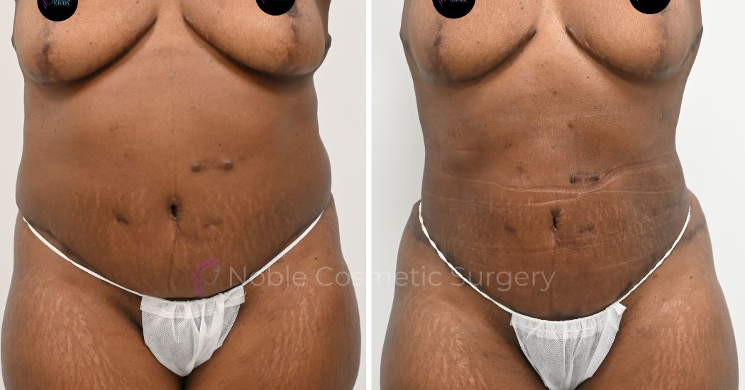 P18-00918L | Before and After Liposuction 1